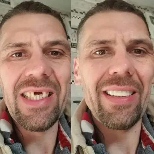 NESLEMY® BioFusion Dentures