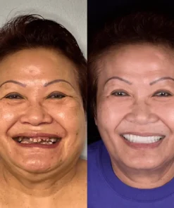NESLEMY® BioFusion Dentures