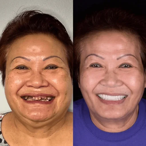 NESLEMY® BioFusion Dentures