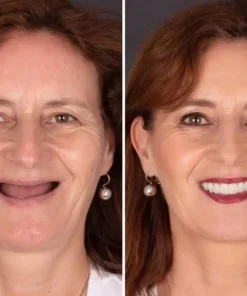 NESLEMY® BioFusion Dentures