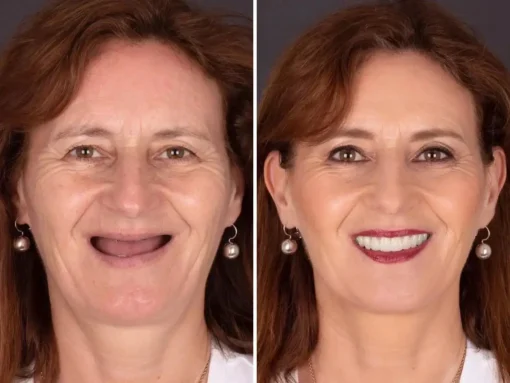 NESLEMY® BioFusion Dentures