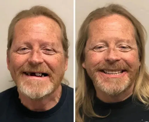 NESLEMY® BioFusion Dentures