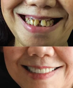 NESLEMY® BioFusion Dentures