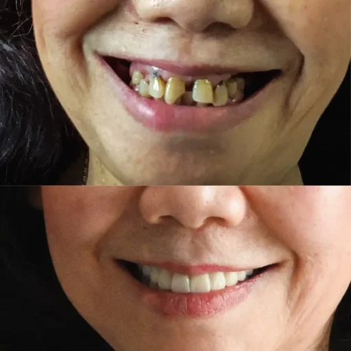 NESLEMY® BioFusion Dentures