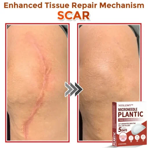 NESLEMY® MicroNeedle Plantic Tag-Clear Patch