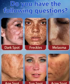NESLEMY™ Blemish Removing Beauty Cream