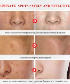 NESLEMY™ Blemish Removing Beauty Cream