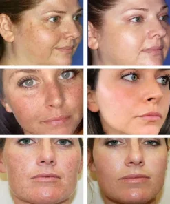 NESLEMY™ Blemish Removing Beauty Cream