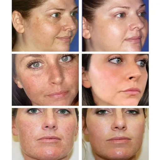 NESLEMY™ Blemish Removing Beauty Cream