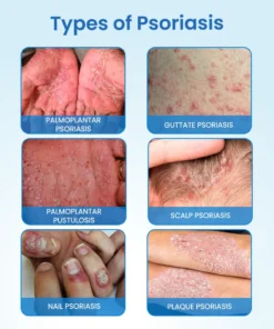 NESLEMY® MagnesiumHerb Psoriasis Relief Cream