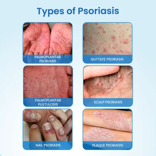 NESLEMY® MagnesiumHerb Psoriasis Relief Cream