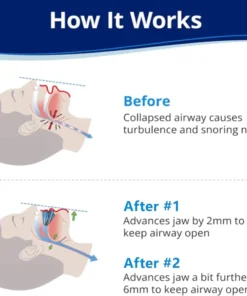 NESLEMY™ Anti-Snoring Mouthpiece