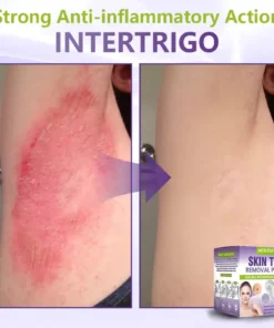 NESLEMY® Soluble Microneedle Botanical Skin Tag Removal Patch