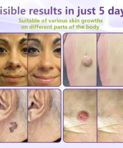 NESLEMY® Soluble Microneedle Botanical Skin Tag Removal Patch
