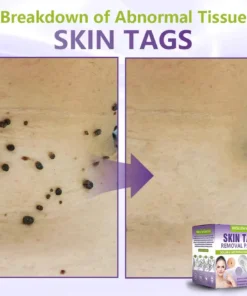 NESLEMY® Soluble Microneedle Botanical Skin Tag Removal Patch