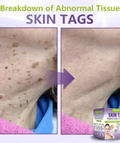 NESLEMY® Soluble Microneedle Botanical Skin Tag Removal Patch