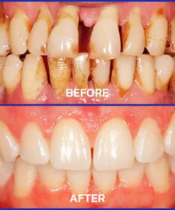 NESLEMY® Bee Venom Dental Treatment Toothpaste