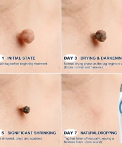 NESLEMY® 7-Day Skin Tag & Spot Eraser Painless & Scar-Free Advanced Imperfection Removal Rollerball Pen