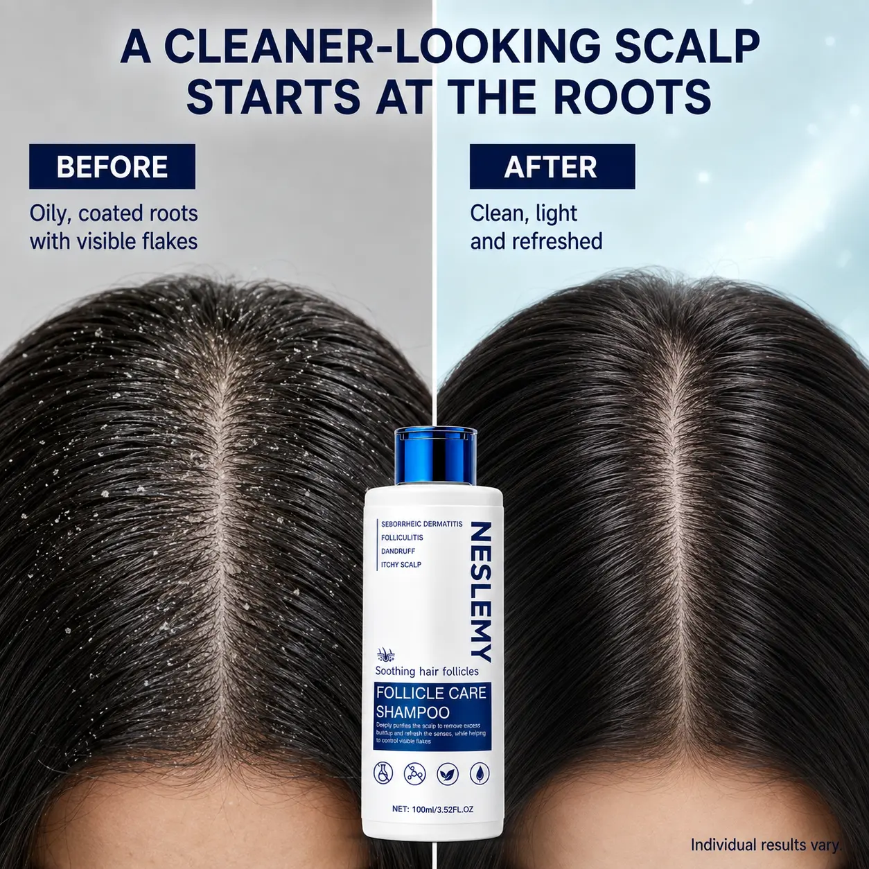 NESLEMY Folliculitis Shampoo for Itchy, Flaky & Oily Scalp